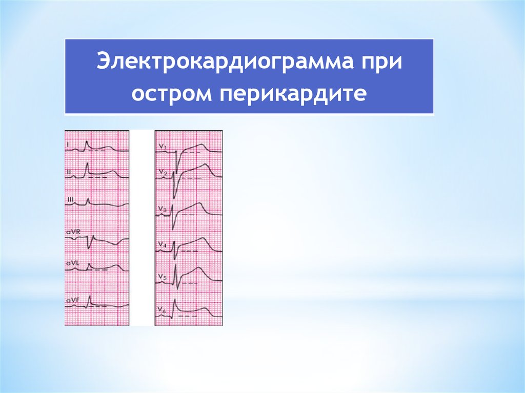 Нарушение миокарда на экг. RSR Тип гипертрофии правого желудочка. ЭКГ критерии хронического легочного сердца. RSR Тип ЭКГ. ЭКГ при легочном сердце.