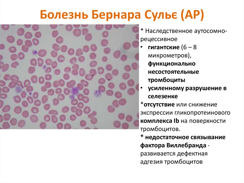 Функциональная активность тромбоцитов. Тромбастения Бернара-Сулье. Тромбоцитопатия Бернара-Сулье. Болезнь Бернара Сулье. Синдром гигантских тромбоцитов.