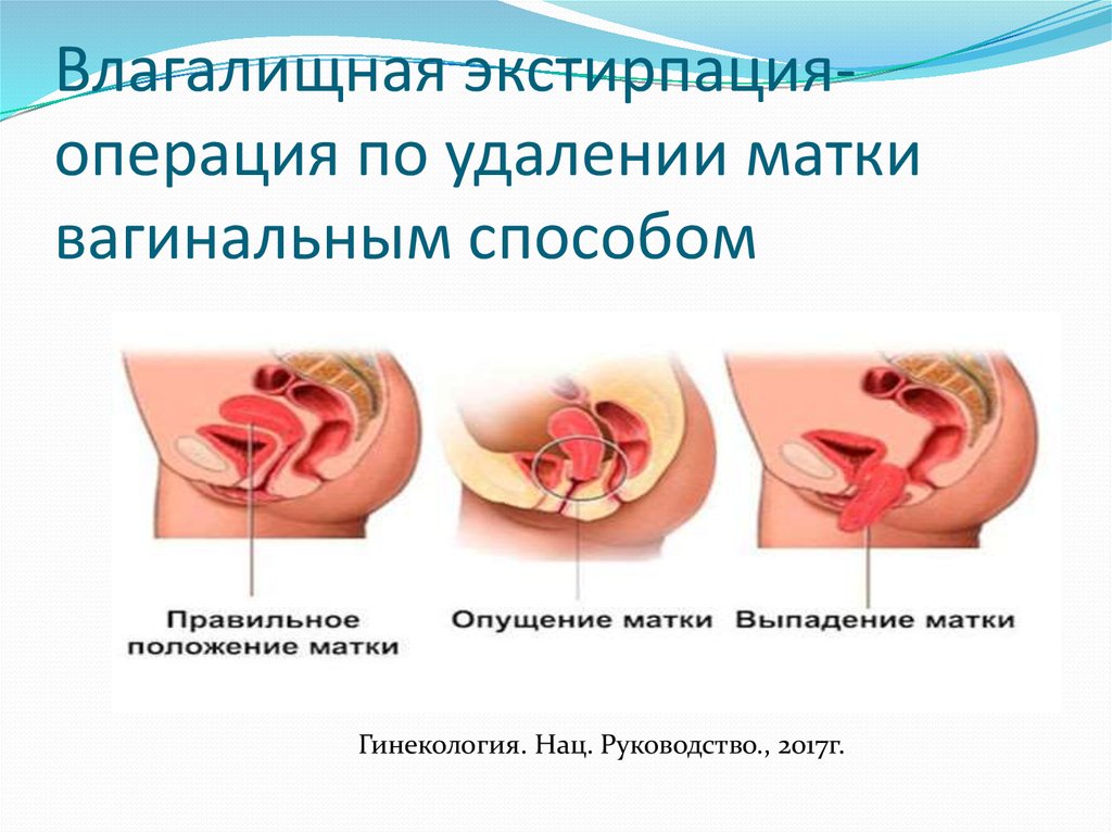 Экстирпация матки с придатками и без - лапароскопическая операция. - Хирург К. В. Пучков