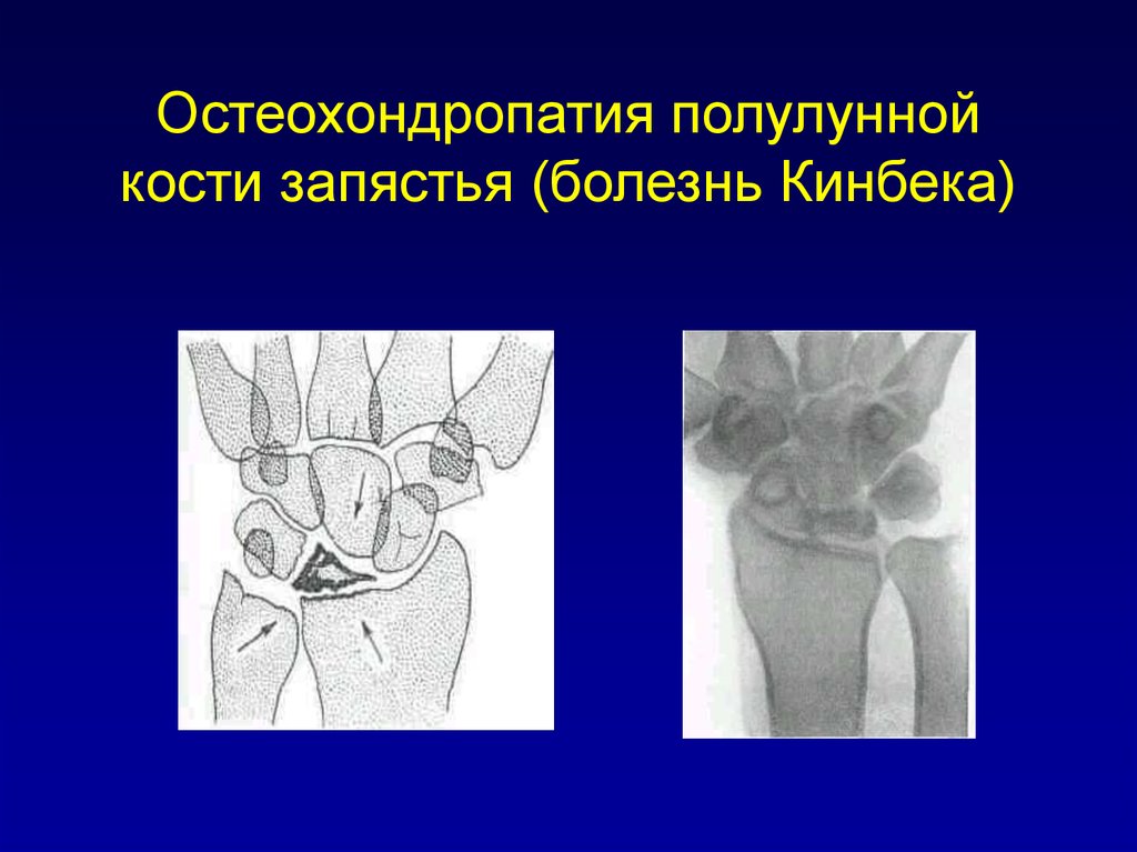 Остеохондропатии у детей презентация