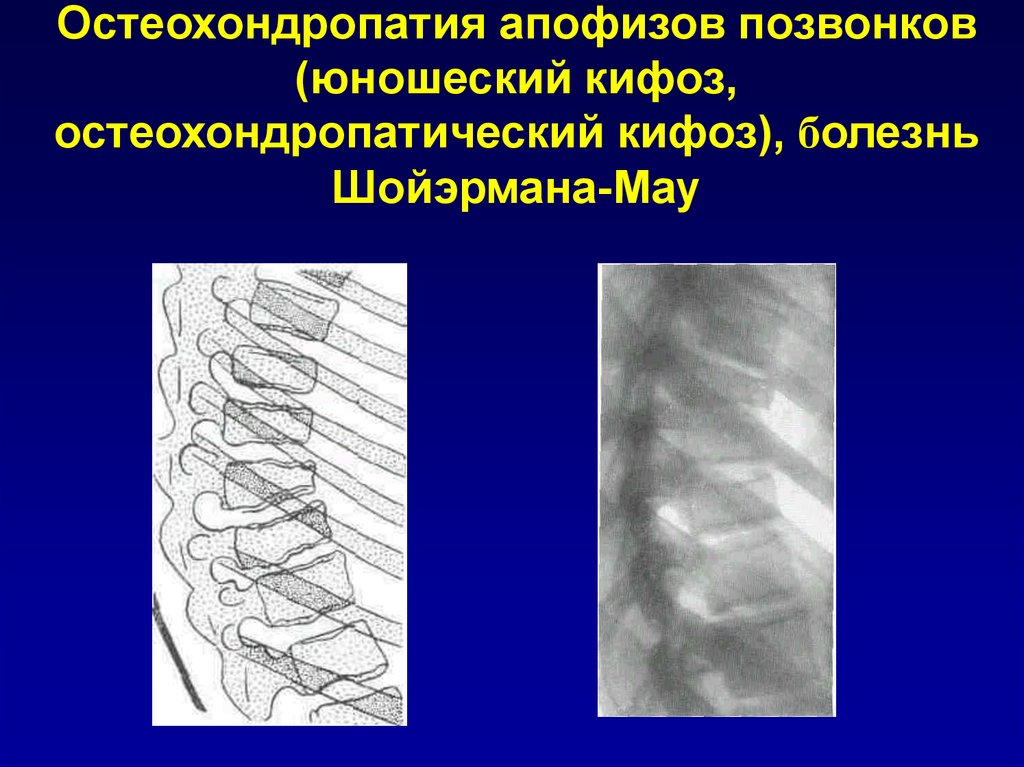 Болезнь шейермана по утвержденным клиническим рекомендациям