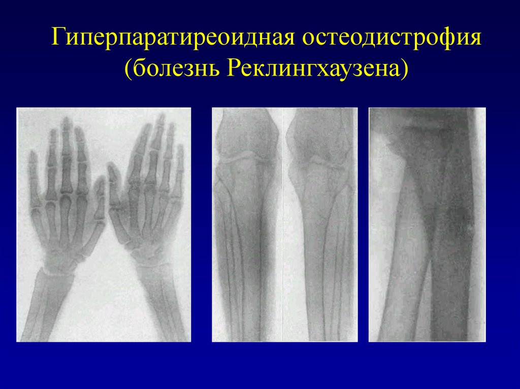 Наследственная остеодистрофия альбрехта презентация