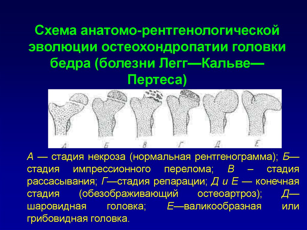 Импрессионный перелом головки бедренной кости. Стадии остеохондропатии головки бедренной кости рентген. Грибовидная деформация головки бедренной кости. Остеохондропатия головки плечевой кости. Стадии остеохондропатии.