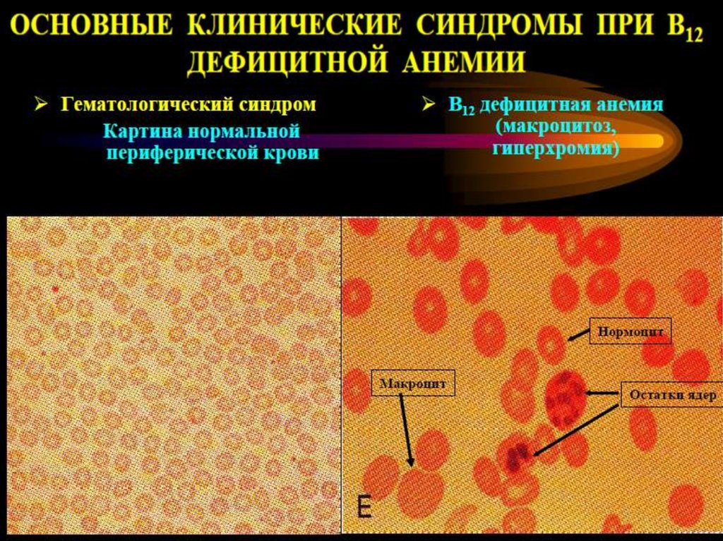 Анемия в12 дефицитная анемия презентация