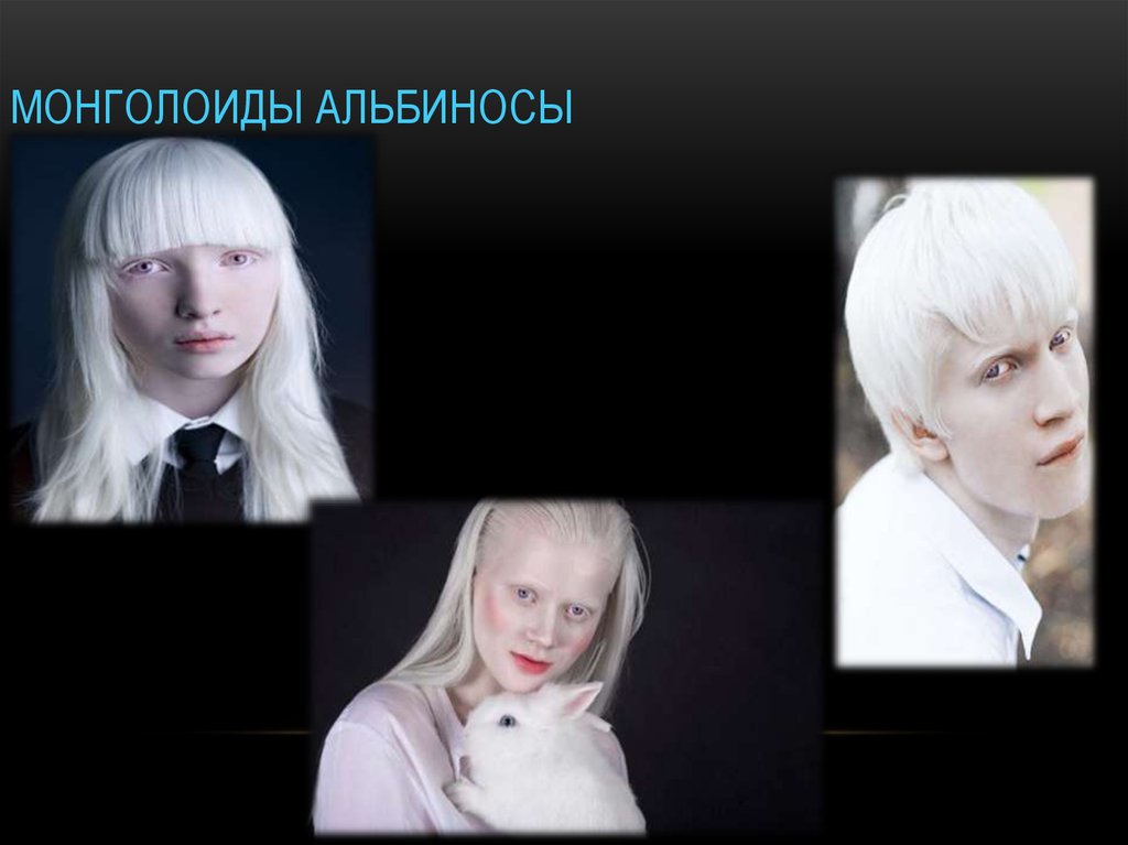 Альбинизмом страдают. Альбинизм это геномная мутация. Монголоиды альбиносы. Цотне Иванишвили альбинос.