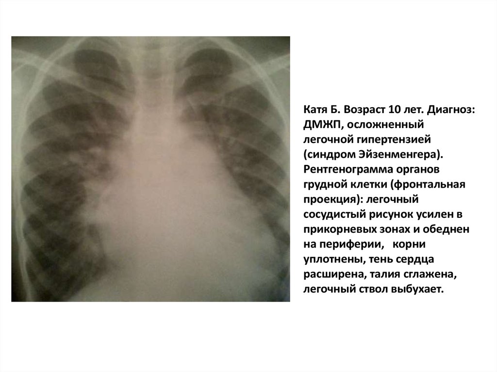 Катя Б. Возраст 10 лет. Диагноз: ДМЖП, осложненный легочной гипертензией (синдром Эйзенменгера). Рентгенограмма органов грудной