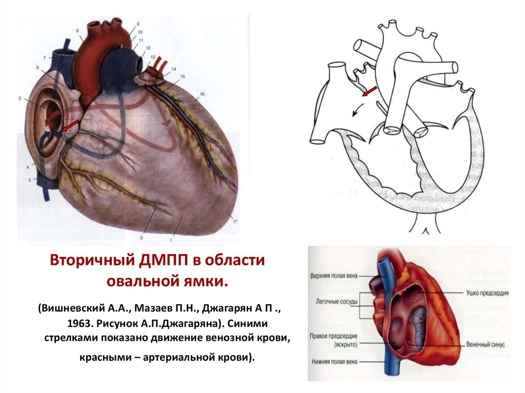 Дмпп у детей презентация