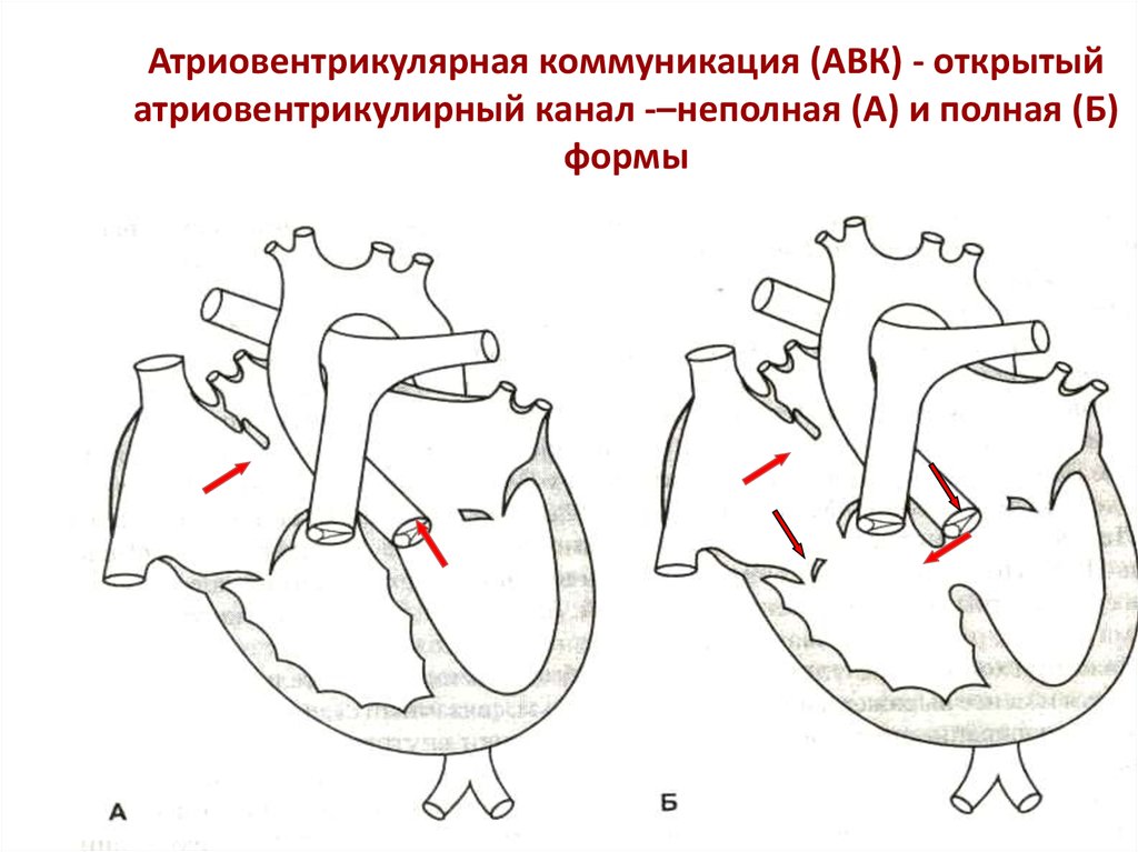 Открытый атриовентрикулярный канал презентация