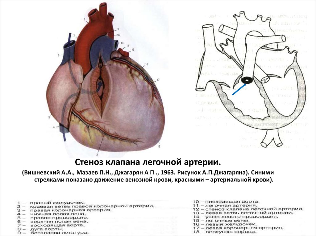 Стеноз легочной артерии. Сужение устья легочной артерии. Сужение легочного клапана сердца. Стеноз клапана легочной артерии. ВПС стеноз клапана легочной артерии.