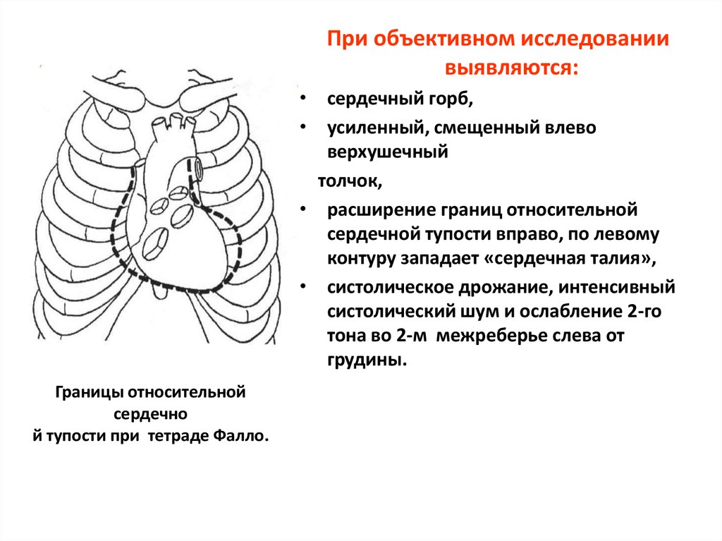 Границы сердца. Тетрада Фалло границы сердца. Расширение границ сердца. Границы сердца при врожденных пороках сердца расширены. Границы относительной сердечной тупости.