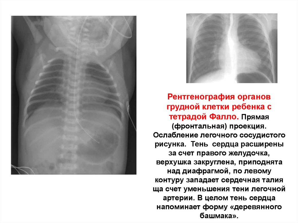 Рентген грудному ребенку. Тетрада Фалло на рентгенограмме. Тетрада Фалло описание рентгенограммы. Рентген грудной клетки тень сердца.