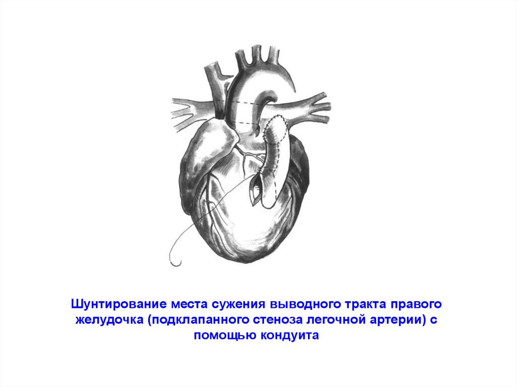 Стеноз легочной артерии. Шунтирование легочной артерии. Выводной тракт правого желудочка. Кондуит легочной артерии.