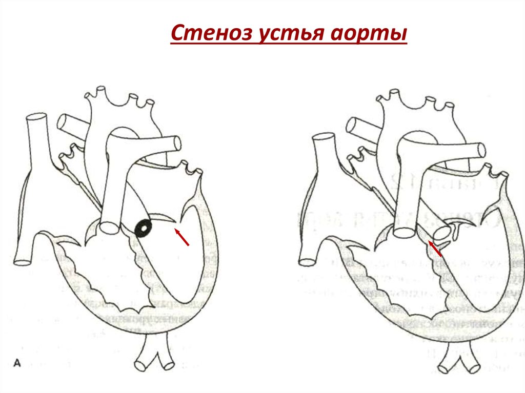 Стеноз это. Стеноз аортального клапана и стеноз устья аорты. Коарктация аорты стеноз устья. Стеноз устья аорты схема. Сужение стеноз устья аорты.