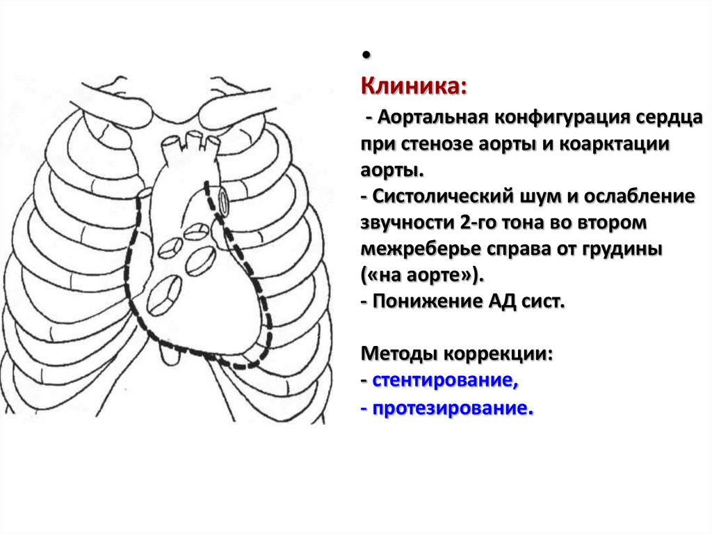 Аортальная конфигурация сердца схема