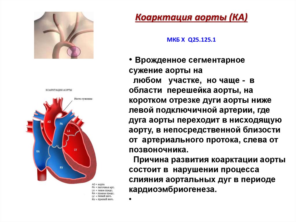 Коарктация аорты (КА) МКБ Х Q25.125.1