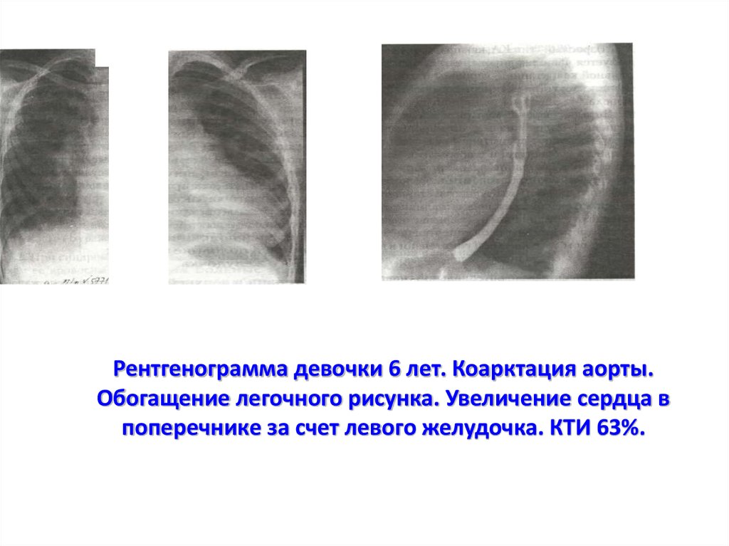 Рентгенограмма девочки 6 лет. Коарктация аорты. Обогащение легочного рисунка. Увеличение сердца в поперечнике за счет левого
