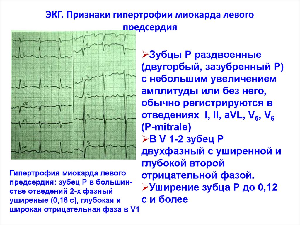 Гипертрофия миокарда рисунок