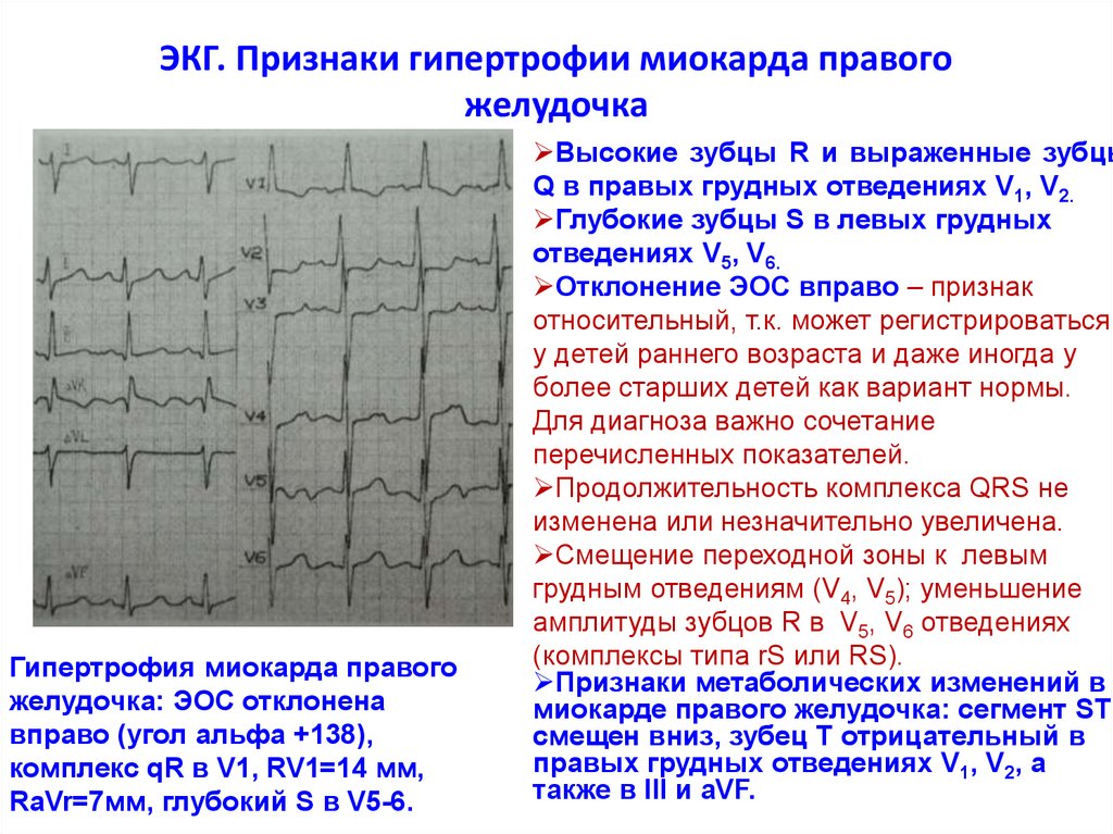 Диастолическая перегрузка левого желудочка на экг картинка