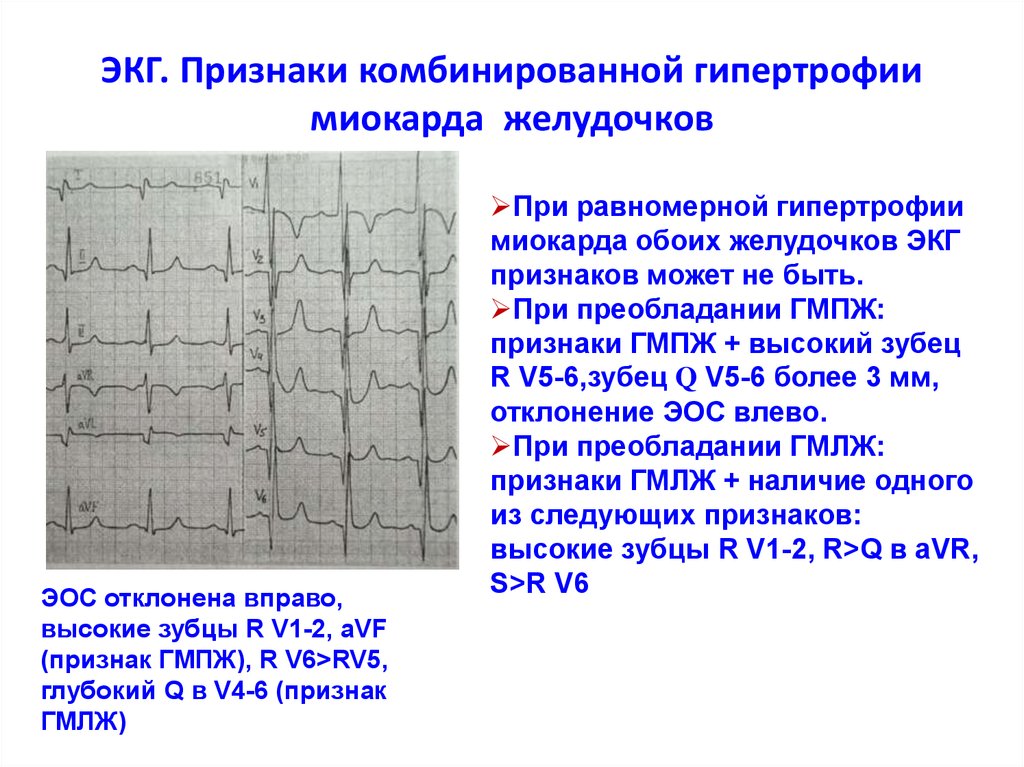 Изменения миокарда умеренные на экг что значит. Гипертрофия обоих желудочков на ЭКГ. ЭКГ при гипертрофии обоих желудочков. ЭКГ синдром гипертрофии желудочков. ЭКГ-признаки гипертрофии миокарда желудочков.