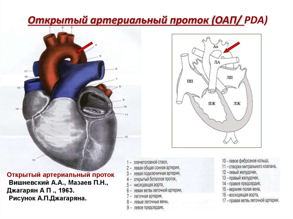 Легочный ствол рисунок. Открытый артериальный (боталлов) проток гемодинамика. Врожденный порок сердца открытый артериальный проток. Строение сердца Баталов проток. Врожденный порок сердца ОАП что это.