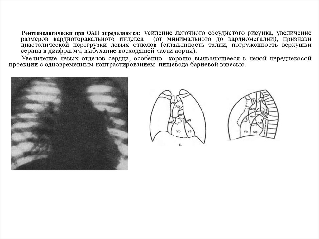 Усиление сосудистого рисунка. Рентгенологически усиление сосудистого рисунка.. Усиление сосудистого легочного рисунка. Рентгенологически усиление легочного рисунка. Открытый артериальный проток рентген.