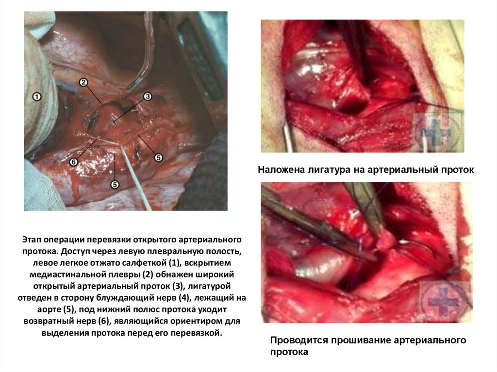 Этап операции перевязки открытого артериального протока. Доступ через левую плевральную полость, левое легкое отжато салфеткой