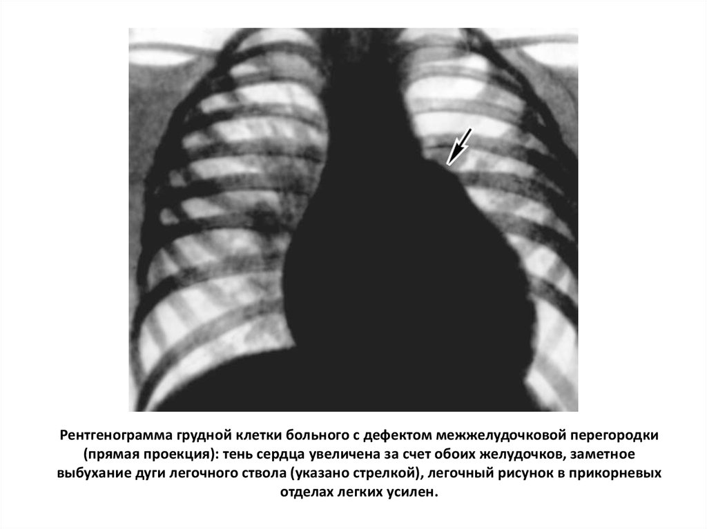 Рентгенограмма грудной клетки больного с дефектом межжелудочковой перегородки (прямая проекция): тень сердца увеличена за счет