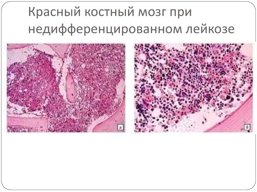 Красный костный мозг при недифференцированном лейкозе