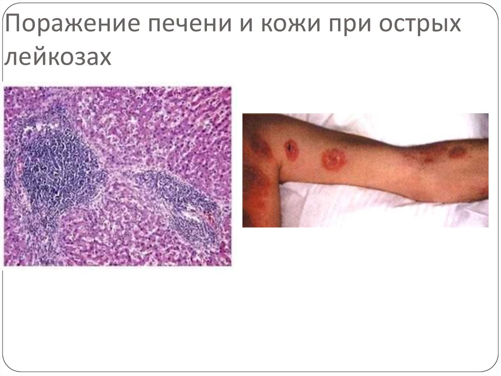 Поражение печени и кожи при острых лейкозах