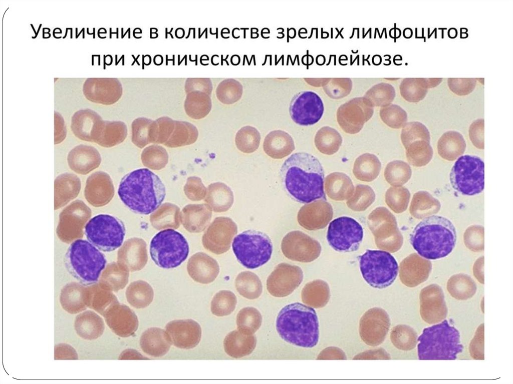 Картина крови при лейкозе у детей