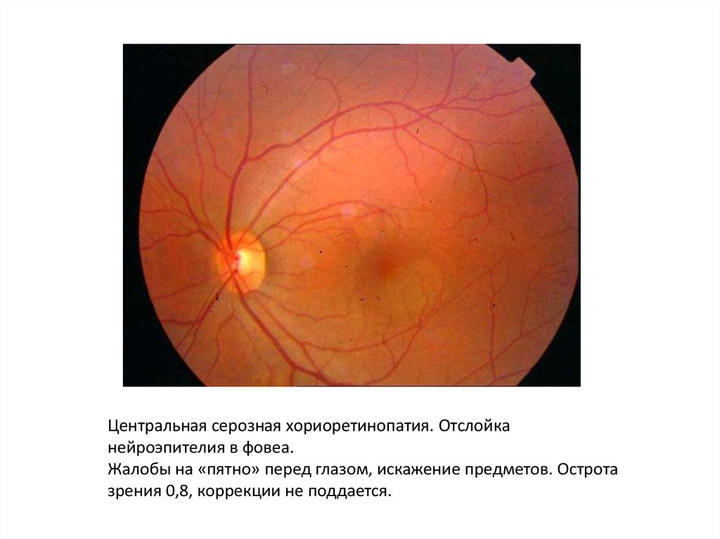 Центральная серозная хориоретинопатия. Экссудативная отслойка сетчатки. Центральная серозная хориоретинопатия глазное дно. Тракционная отслойка сетчатки. Центр сетчатки