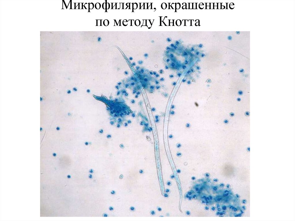Микрофилярии, окрашенные по методу Кнотта
