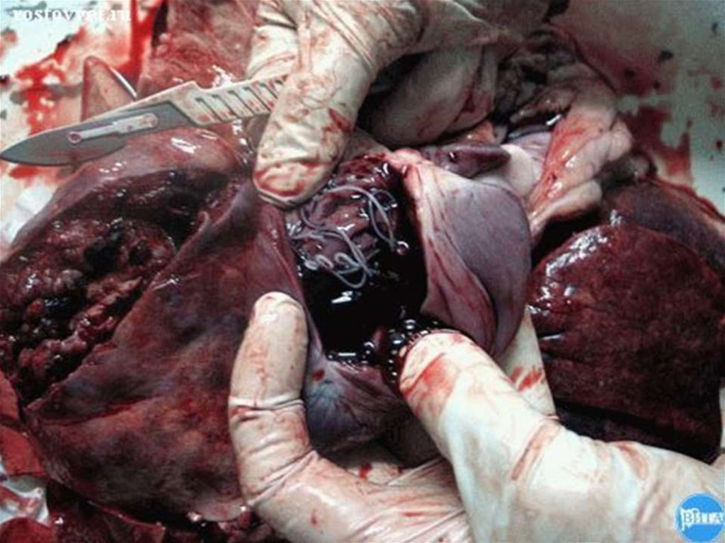 Ужасная (зловещая) нить в сердце