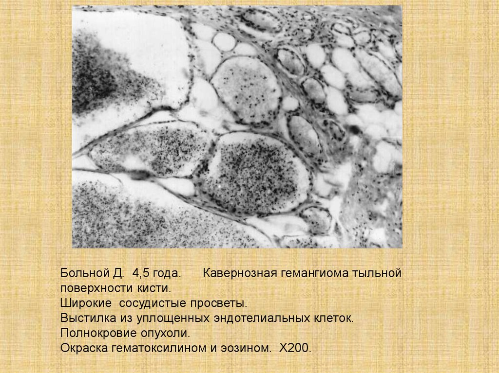 Д болен. Эндотелиальная выстилка. Уплощенные клетки. Уплощенное ядро.