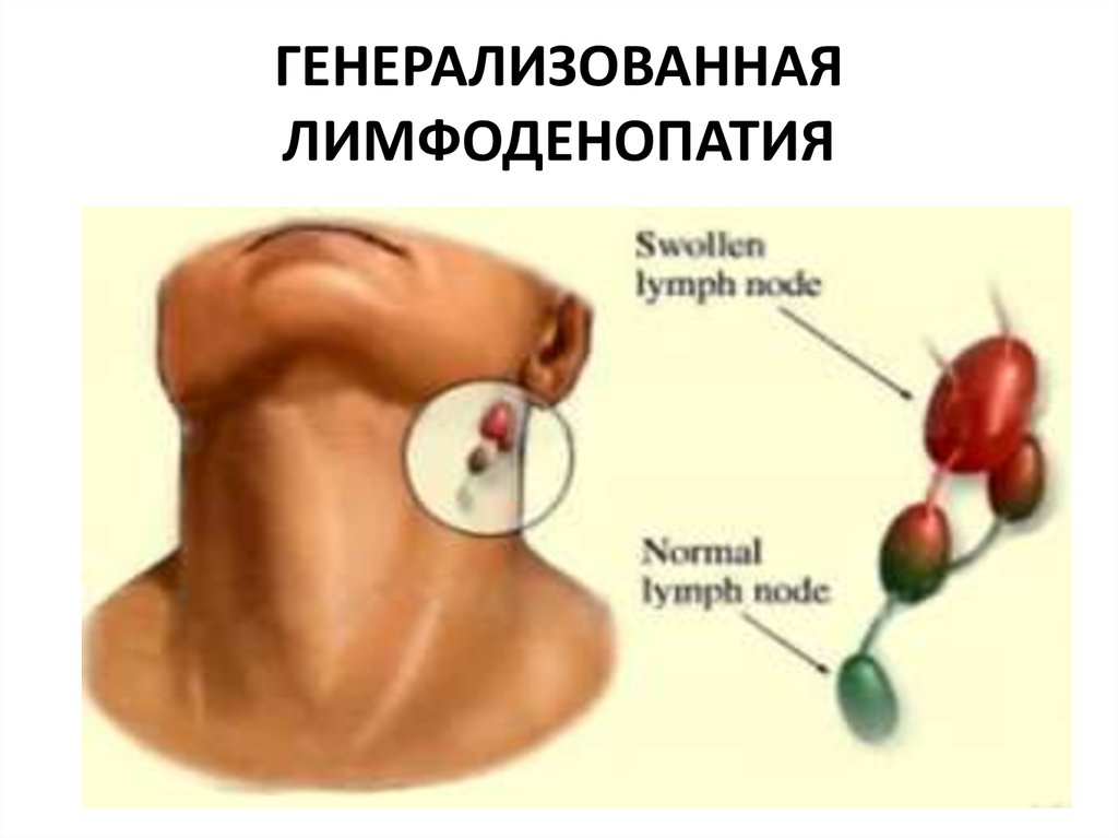 Лимфоденопатия