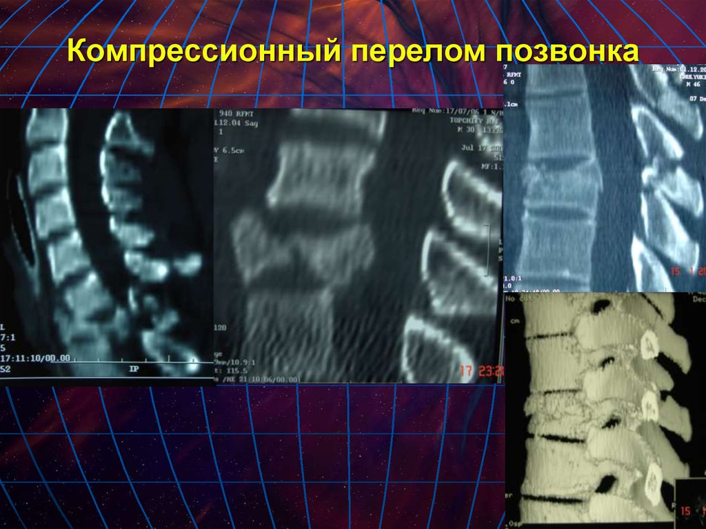 Компрессионный позвоночник. Компрессионный перелом позвоночника тн6. Компрессионный перелом л3 л4. Компрессионный перелом тел c5 c6. Неосложненный компрессионный перелом th12 l1.