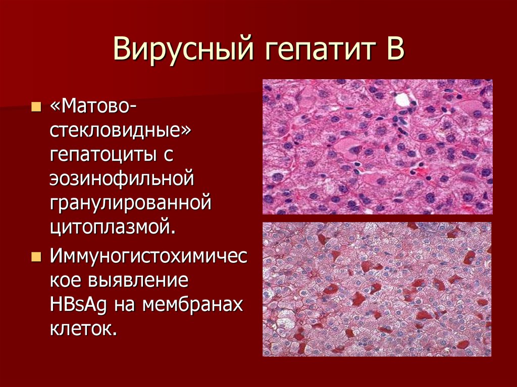 Изменения клеток печени. Вирусный гепатит печени микропрепарат. Гепатит гистология микропрепарат. Матово стекловидные гепатоциты. Гепатит с гистология печени.