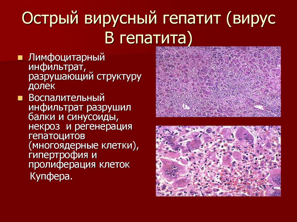 Изменения клеток печени. Вирусный гепатит б патанатомия. Вирусный гепатит макропрепарат патанатомия. Вирусный гепатит в патологическая анатомия макропрепарат. Вирусный гепатит в патологическая анатомия микропрепарат.