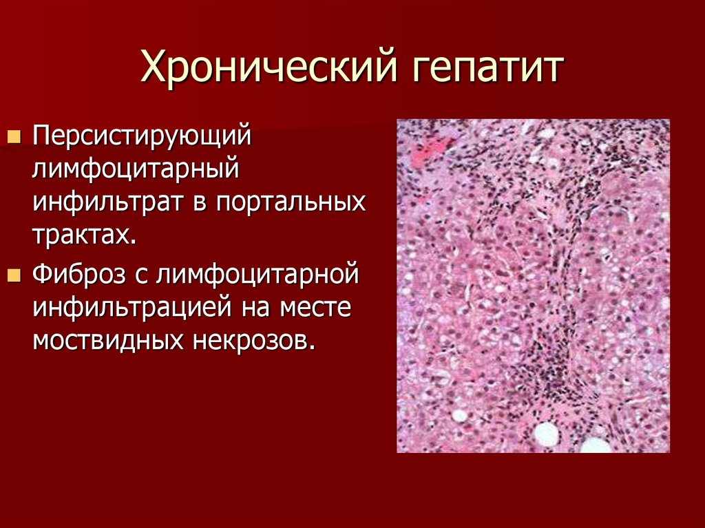 Хронический гепатит это. Лимфогистиоцитарная инфильтрация печени. Лимфоцитарная инфильтрация микропрепарат. Хронический портальный гепатит гистология. Гепатит печени патанатомия.