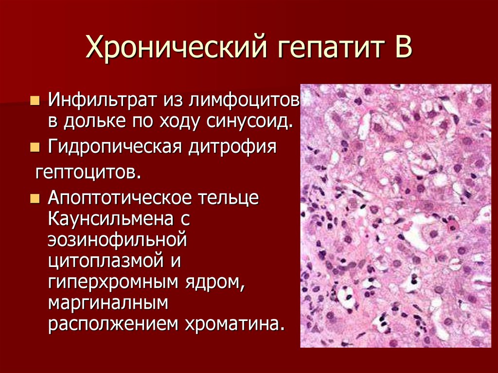 Хронический гепатит что это. Гидропическая дистрофия печени. Хронический гепатит печень. Хронический гепатит фото.