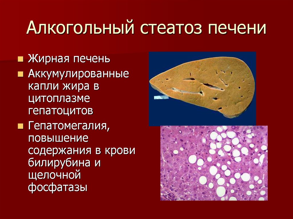 Перерождение клеток печени. Жировой гепатоз (стеатоз) печени. Жировой гепатоз печени гистология. Неалкогольный стеатоз печени. Жировая дистрофия печени (стеатоз печени).