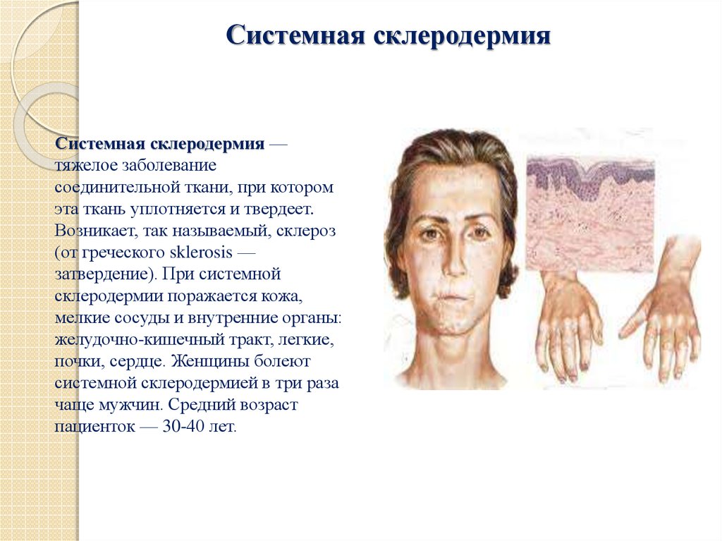 Патология тканей. Склеродермия поражения системная поражения. Системная склеродермия диагностика мкб 10. Системная склеродермия мкб 10 у взрослых. При системных заболеваниях соединительной ткани поражаются.