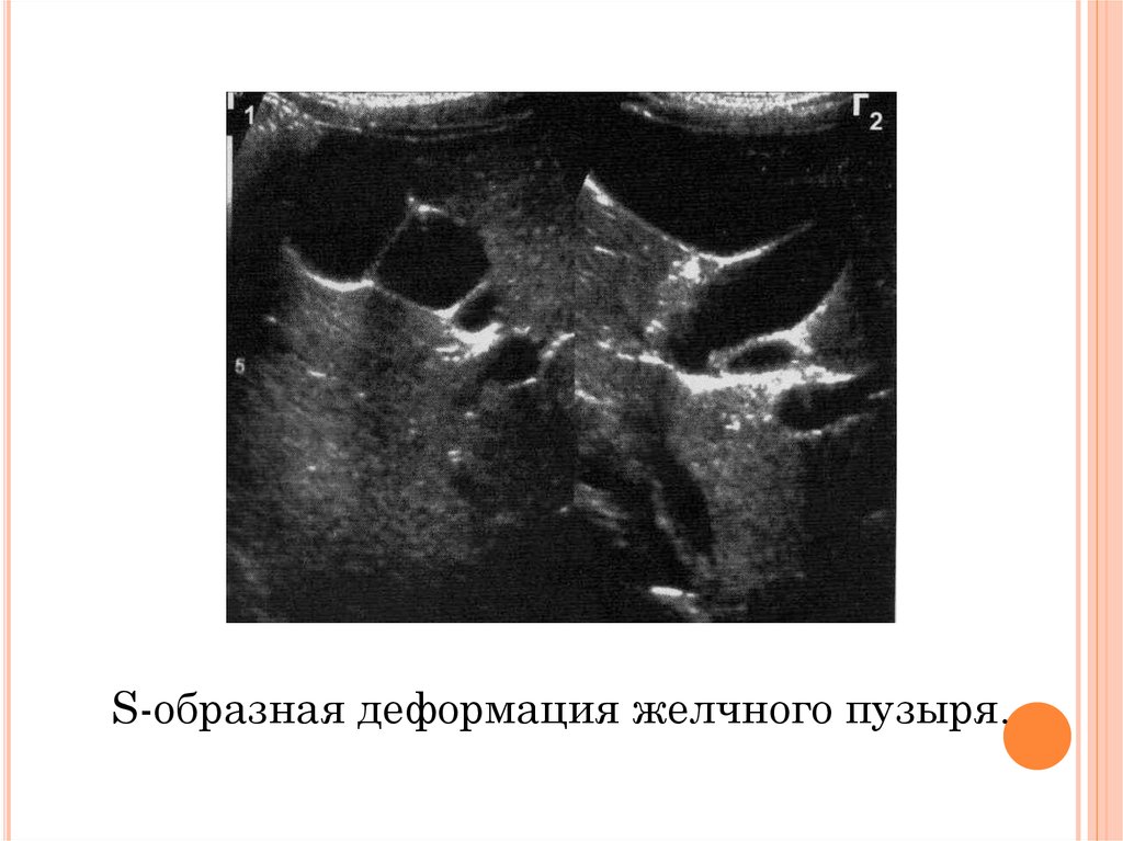 Деформация желчного пузыря. S образный желчный пузырь УЗИ. УЗИ картина деформации в желчном пузыре. Деформация желчного пузыря УЗИ. Желчный пузырь при деформации УЗИ.