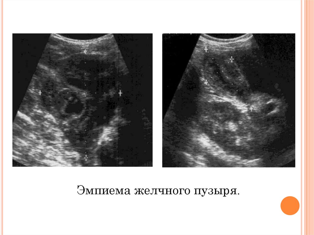 Узи желчного пузыря. Эмпиема желчного пузыря на УЗИ. Эмпиема желчного пузыря УЗИ картина. Перфорация желчного пузыря УЗИ картина. Водянка желчного пузыря по УЗИ.