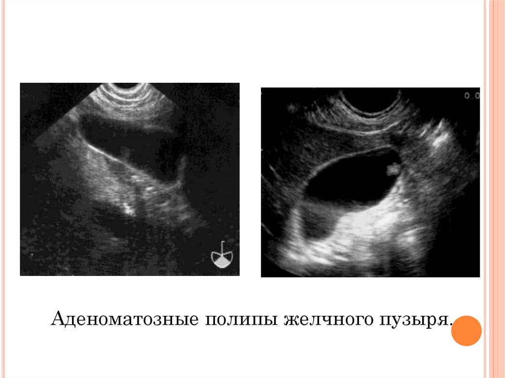 Холестериновый полип на УЗИ. Полипоз желчного пузыря на УЗИ. Полип желчного пузыря на УЗИ. Полип желчного пузыря на УЗИ описание.