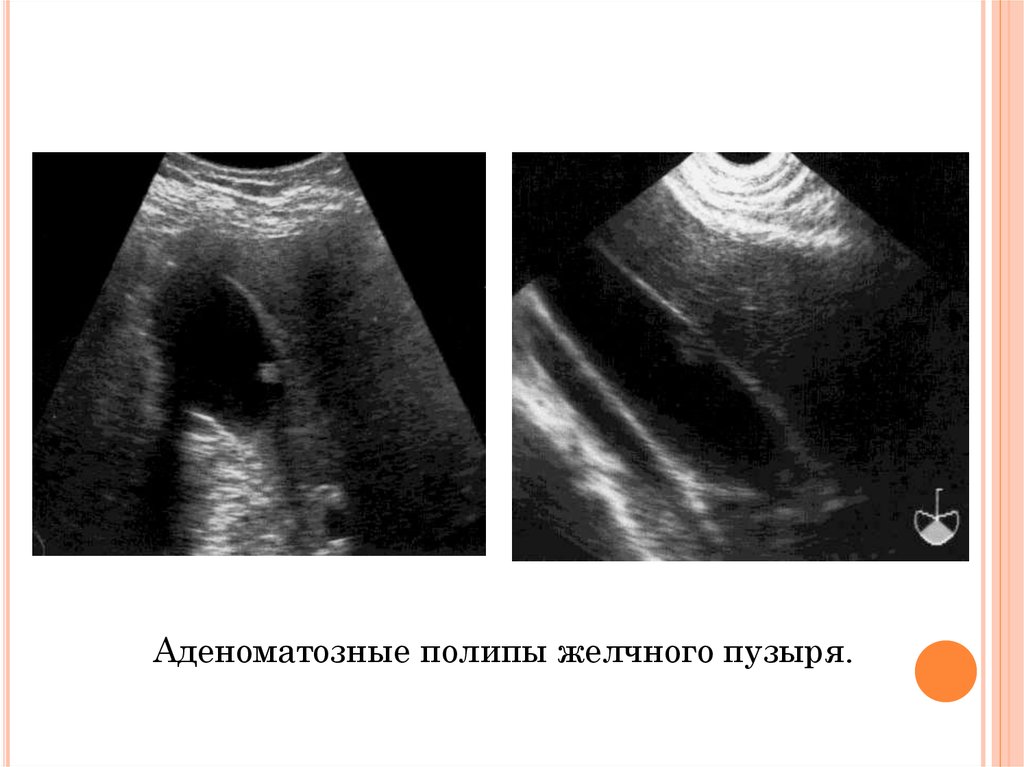 Признаки полипа желчного пузыря. Полип желчного пузыря на УЗИ. Полипоз желчного пузыря на УЗИ. УЗД полипов желчного пузыря. Полим желчно пузыря УЗИ.