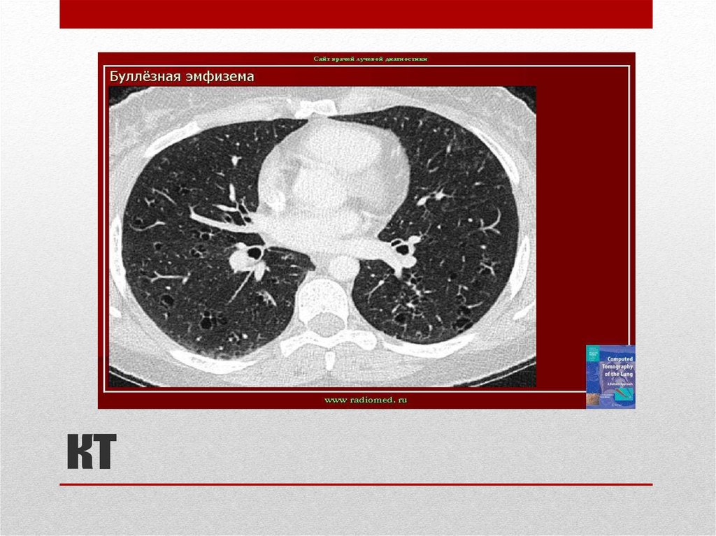 Кт легких акция. Буллёзная эмфизема лёгких кт что это. Кт картина буллезной эмфиземы\. Хроническая обструктивная болезнь легких кт.