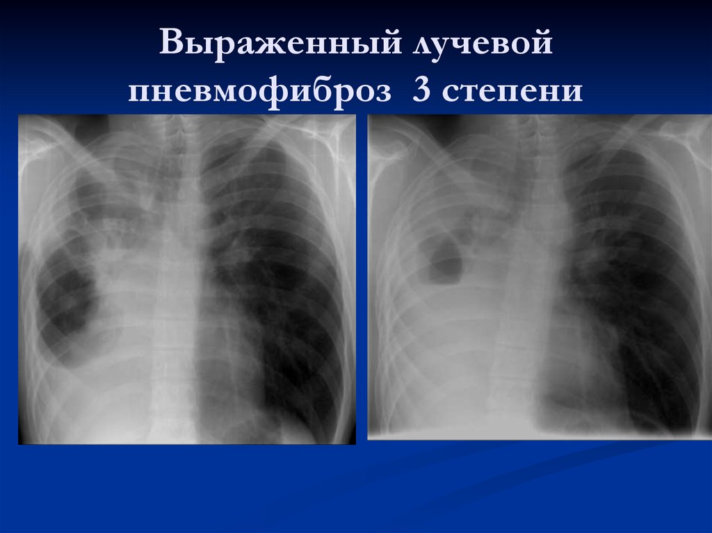 Пневмофиброз это. Постлучевой пневмофиброз. Посттравматический пневмофиброз. Пневмофиброз в базальных отделах легких что это.