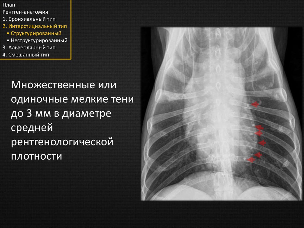 Анатомия рентген. Рентген легких анатомия. Ренгентанатомия лёгких. Рентгенологическая анатомия легких. Рентгенограммы анатомия.