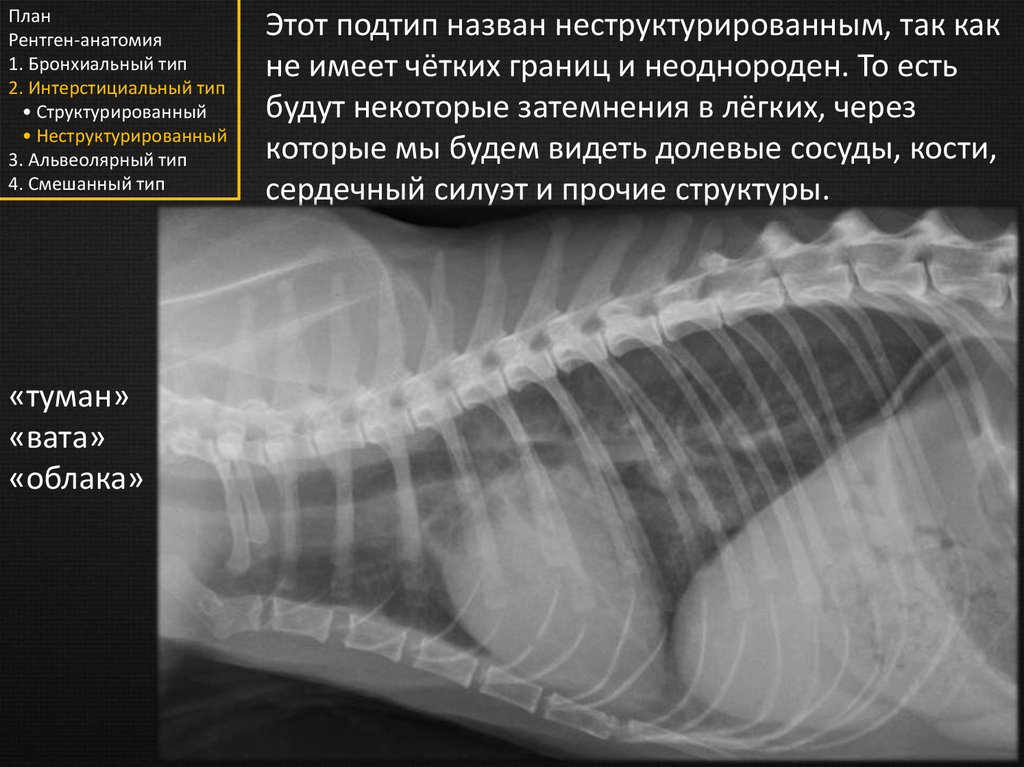 Имеет четких границ. Затемнения интерстициального типа. Затемнения бронхиального типа. Интерстициальный неструктурированный Тип затемнения рентген. Лёгкие анатомия рентген.